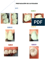 PRÁCTICA. Preparación de Cavidades