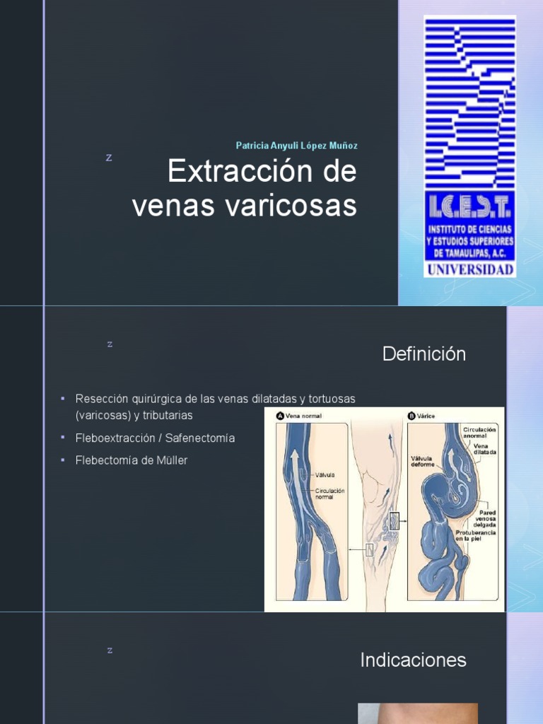 Extracción de Venas Varicosas PDF Venas varicosas Sistema