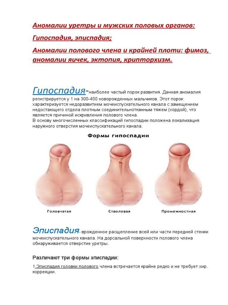 Лечение эписпадии в Турции