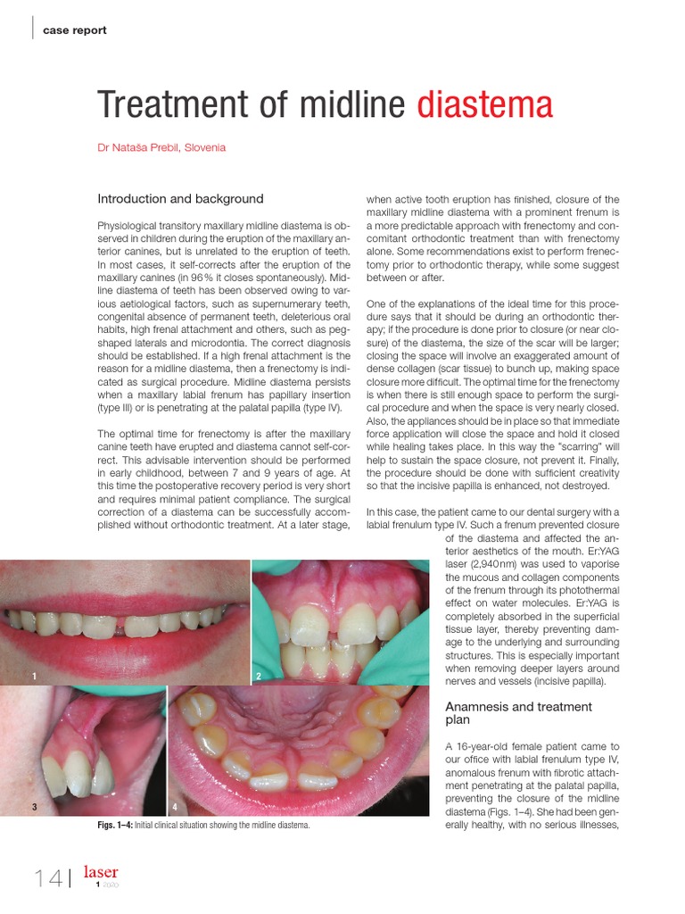 Treatment of Midline Diastema PDF Orthodontics Tooth