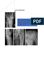 Metabolic Bone Disease: Figure 1. Distal Radius Fracture in An 81-Year-Old Man With A History of