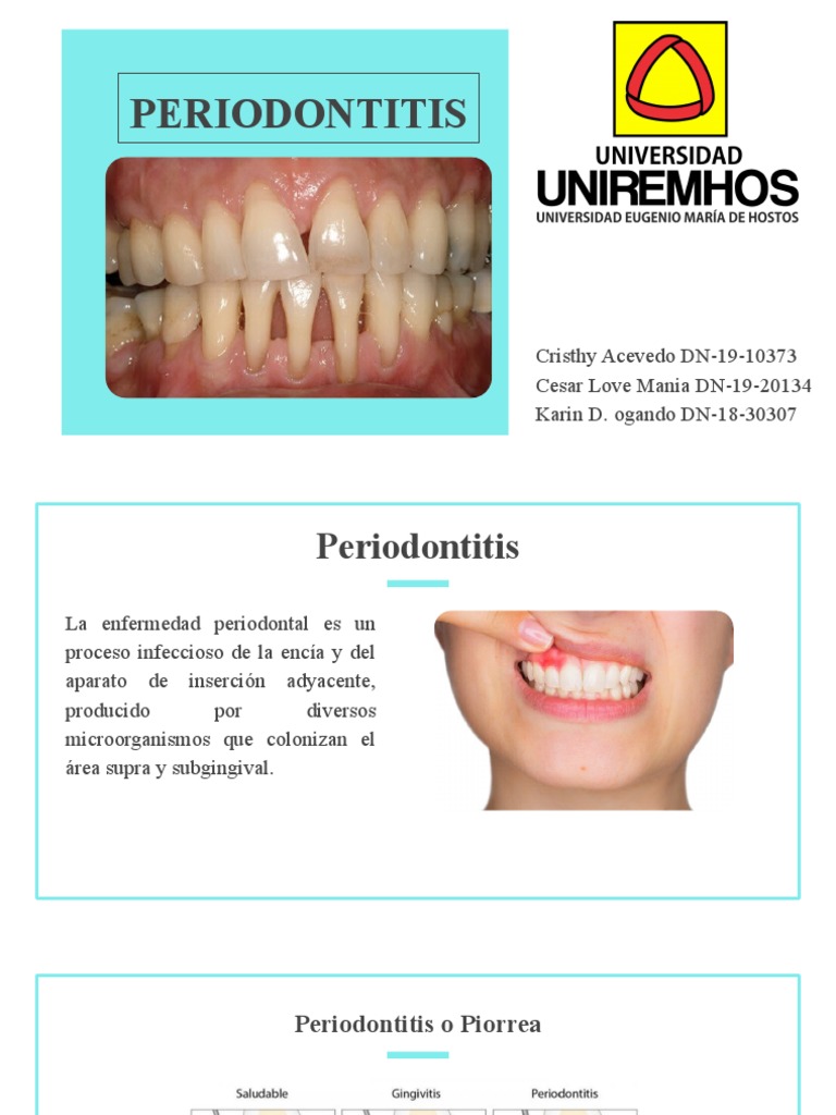 Periodontitis | PDF