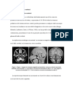 Sindrome de Tallo Cerebral (1)