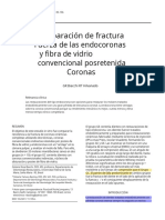 2012biacchi Resistencia de Fractura Endocrown vs Coronas_postefibravidrio Molares.en.Es (1)