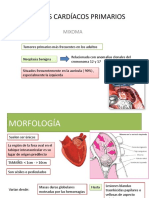 Tumores cardíacos primarios: Mixoma, lipoma y fibroelastoma