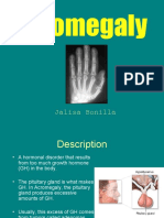 Acromegaly: Jalisa Bonilla