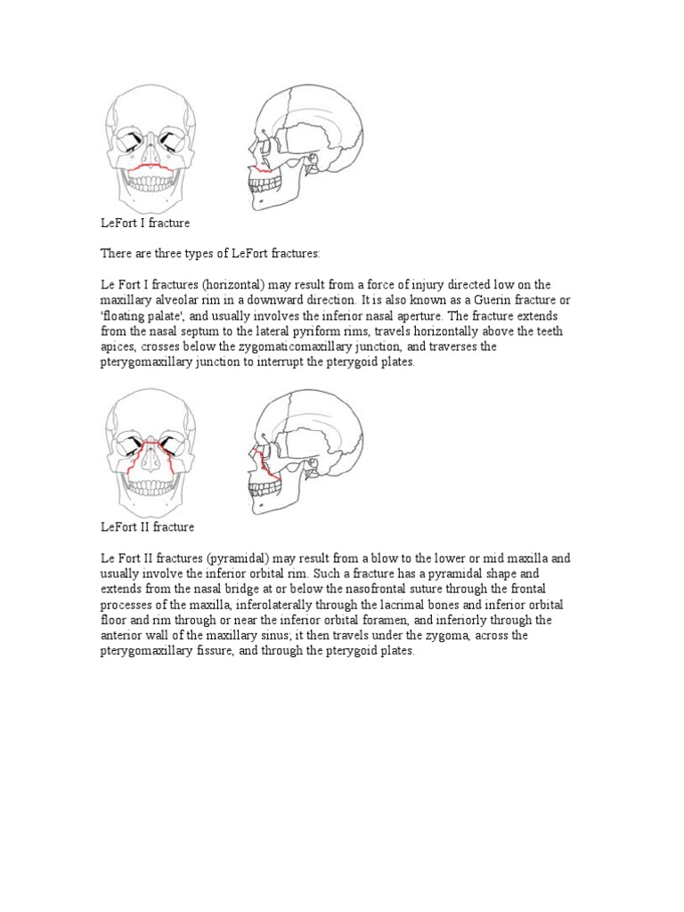 LeFort I Fracture | Human Head And Neck | Human Anatomy