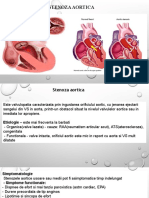 Stenoza aortică