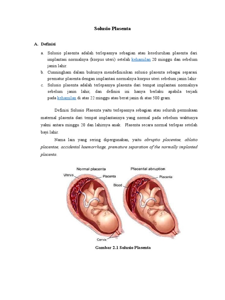 Pemahaman Solusio Plasenta dan Gejalanya | PDF