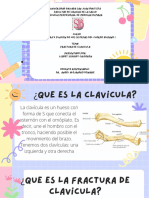 Fractura de Clavicula