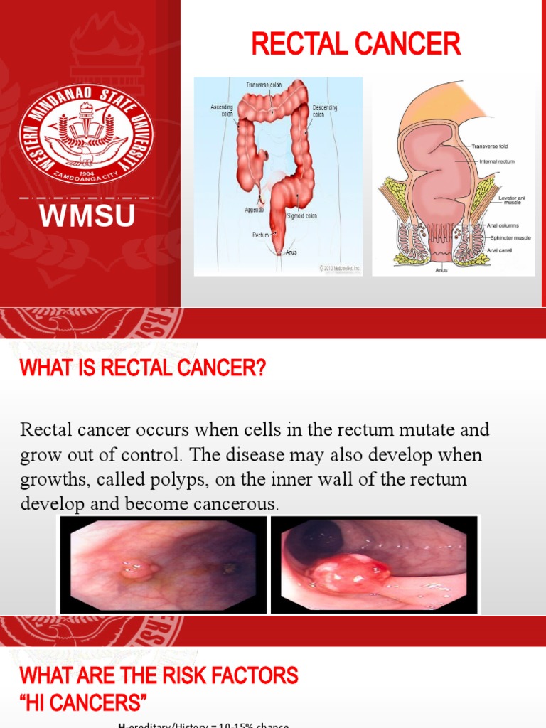 Comprehensive Overview of Rectal Cancer Risk Factors, Signs and