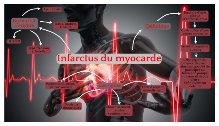 Carte Mentale Infarctus | PDF
