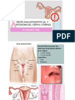 Displasia de Cervix Uterino