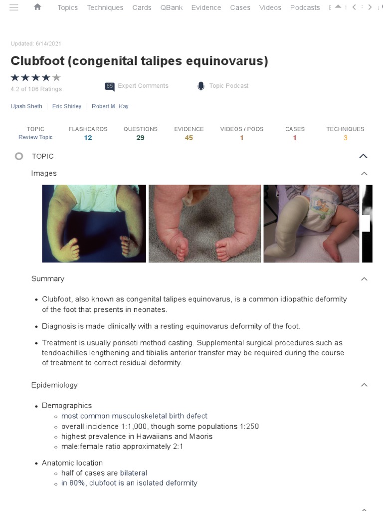 Clubfoot (Congenital Talipes Equinovarus) Pediatrics Orthobullets