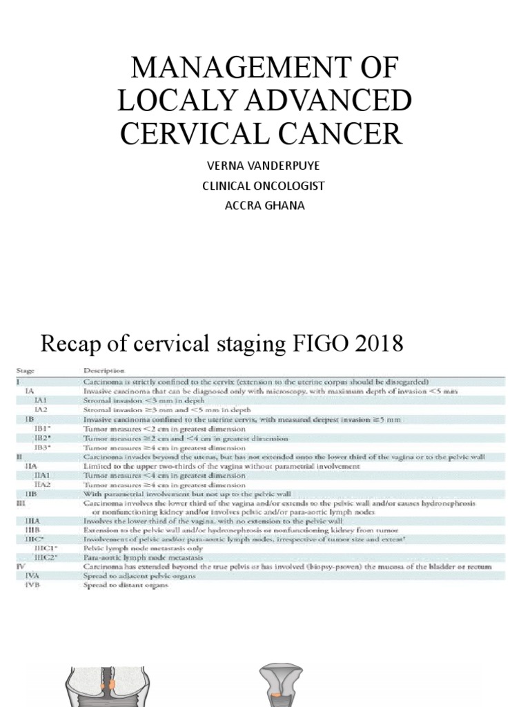 Locally Advanced Cervical Cancer Management | PDF | Cervical Cancer ...