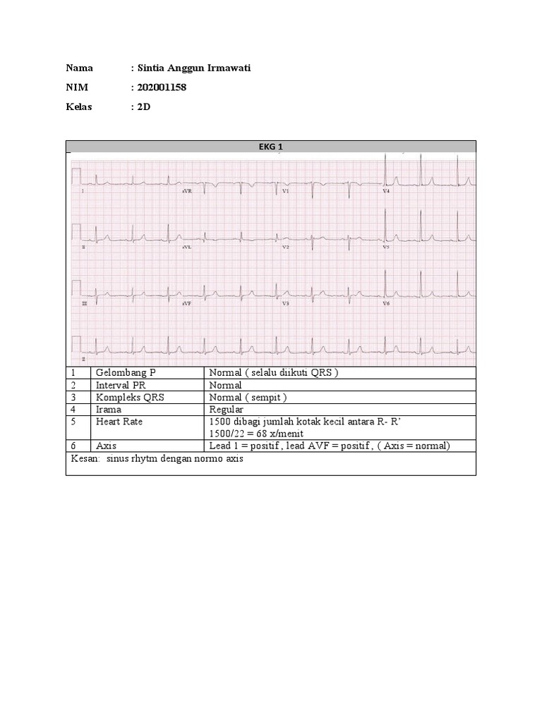 Analisis EKG dengan Normo Axis | PDF