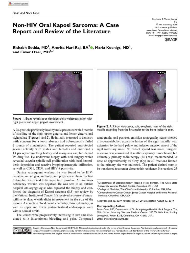 NonHIV Oral Kaposi A Case Report and Review of The Literature
