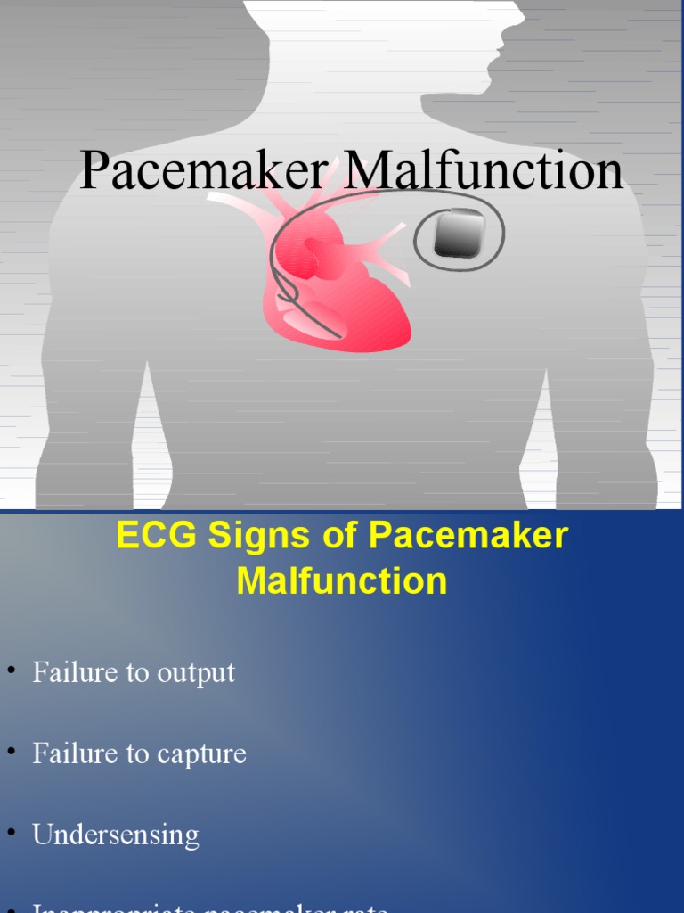 Pacemaker Malfunction Overview | PDF | Artificial Cardiac Pacemaker ...