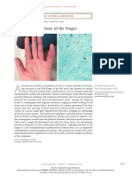 Tuberculosis of The Finger