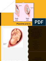 Placenta Previa