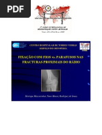 FIXAÇÇÃO COM FIOS vs. PARAFUSOS NAS FRACTURAS PROXIMAIS DO DO RÁDIO. Henrique Mascarenhas; Nuno Moura; Rodriguez de Sousa