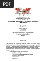 Utilização de Placas no Tratamento das Fracturas dos Óssos do Antebraço no Adulto. Paulo Almeida, Elsa Fonseca, Mário Tapadinhas, João Jacinto, Craveiro Lopes