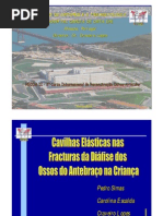 Cavilhas Elásticas no Tratamento das Fracturas dos Ossos do Antebraço na Criança. Pedro Simas, Carolina Escalda, Craveiro Lopes