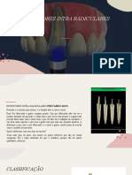 Retentores intra-radiculares pré-fabricados