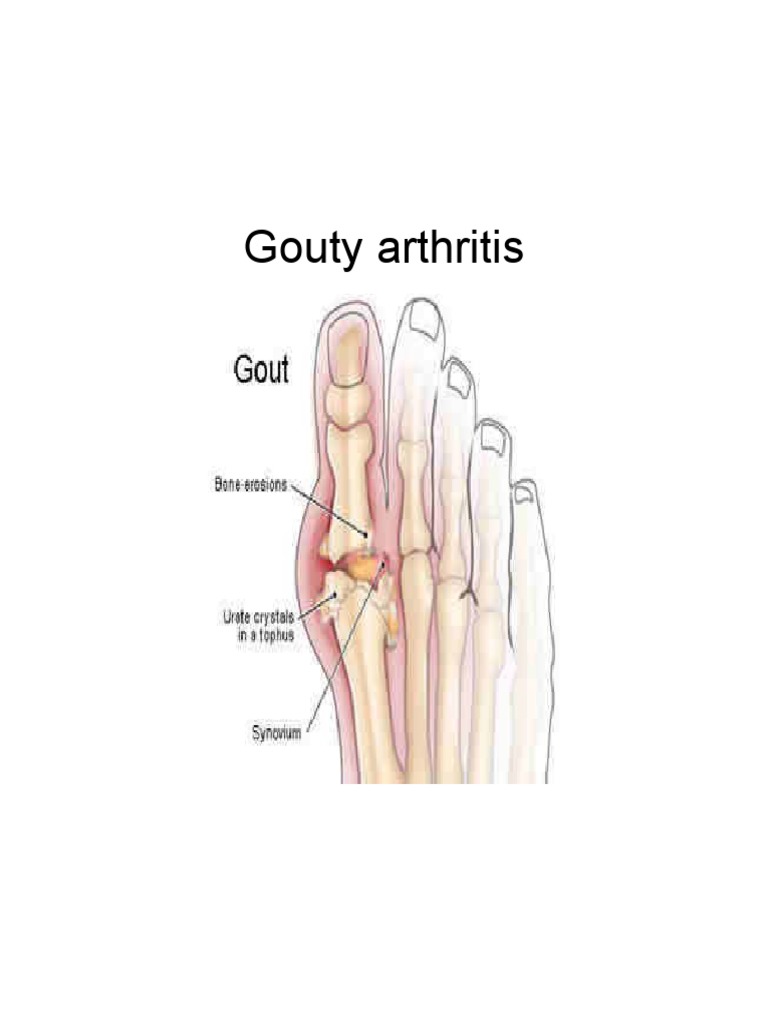 case study of gouty arthritis