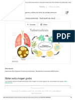 Progresión tuberculosis pulmonar