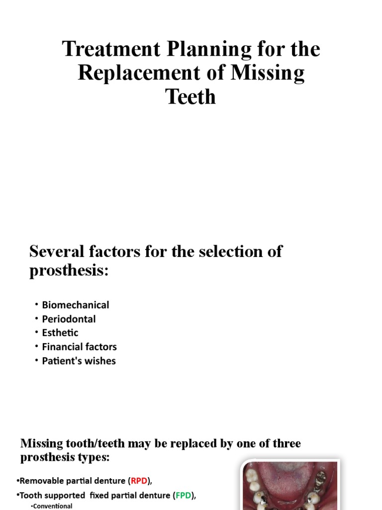 Planning Missing Teeth Replacement | PDF | Dental Implant | Human Tooth
