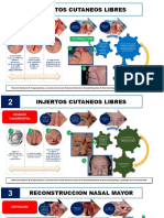 Reconstrucción nasal mayor con injertos cutáneos libres