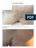 Dermatite Atópica - IMAGEM