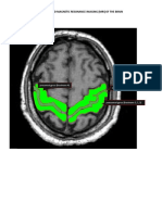 T1-Weighted Magnetic Resonance Imaging (Mri) of The Brain: Central Fissure (Rolandic) Precentral Gyrus (Brodmann 4)