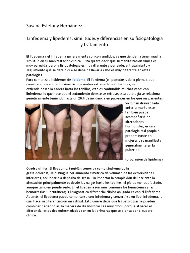 Cómo diferenciar un Linfedema del Lipedema?