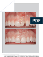 Extraction Site Management in The Esthetic Zone Using Autogenous Hard and Soft Tissue Grafts - A 5-Year Consecutive Clinical Study