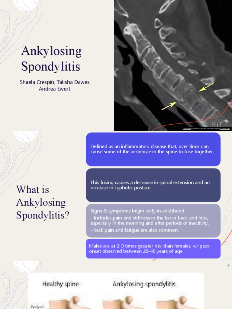 Understanding Ankylosing Spondylitis | PDF | Diseases And Disorders ...