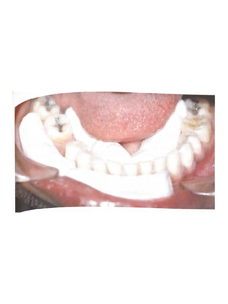 Figure 36.2 Isolation of Mandibular Arch Using Multiple Cotton Rolls PDF