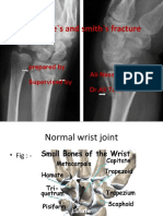 Colle's and Smith's Fracture: Prepared by Ali Nassser Supervised by DR - Ali Taha