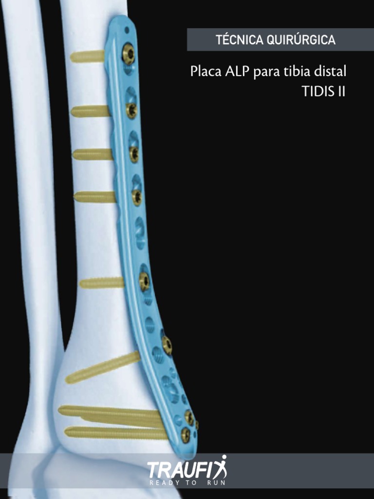 Técnica quirúrgica para la fijación de fracturas de tibia distal con ...
