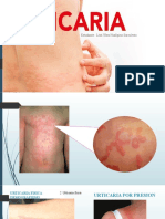 Urticaria