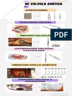 Cambio de Valvula Aortica: Aortotomia