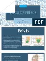 Tipos de Pelvis