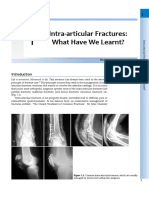 Intra Articular Fractures