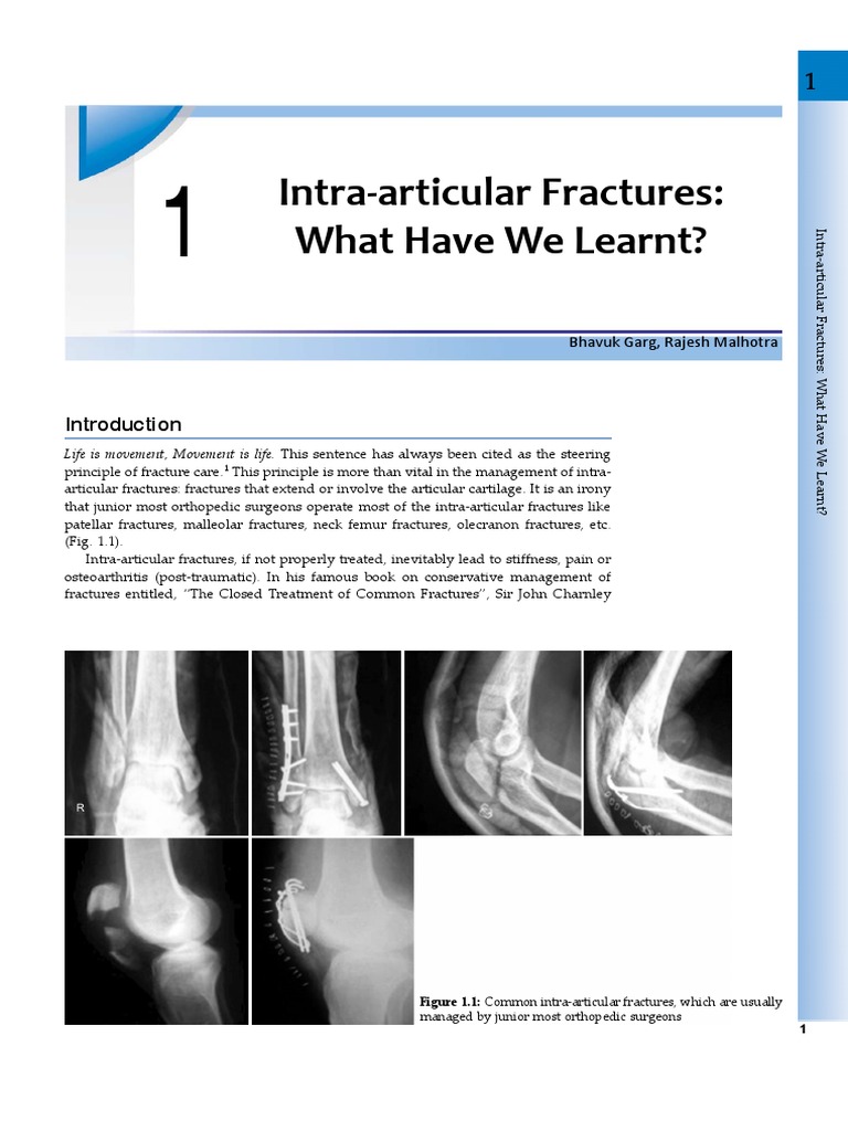 Intra Articular Fractures | PDF | Shoulder | Osteoarthritis