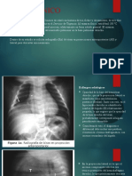 Caso Clinico Eventracion Diafragmatica