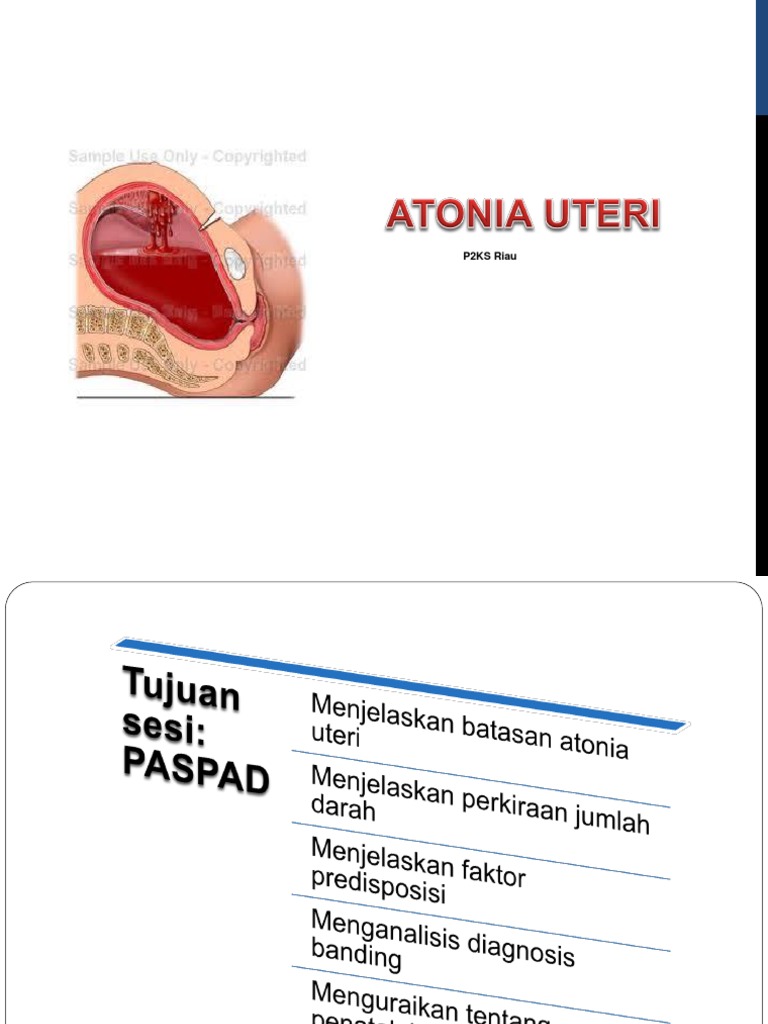 Atonia Uteri PDF