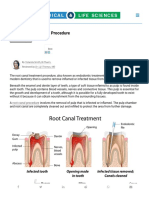 Root Canal Treatment Procedure 