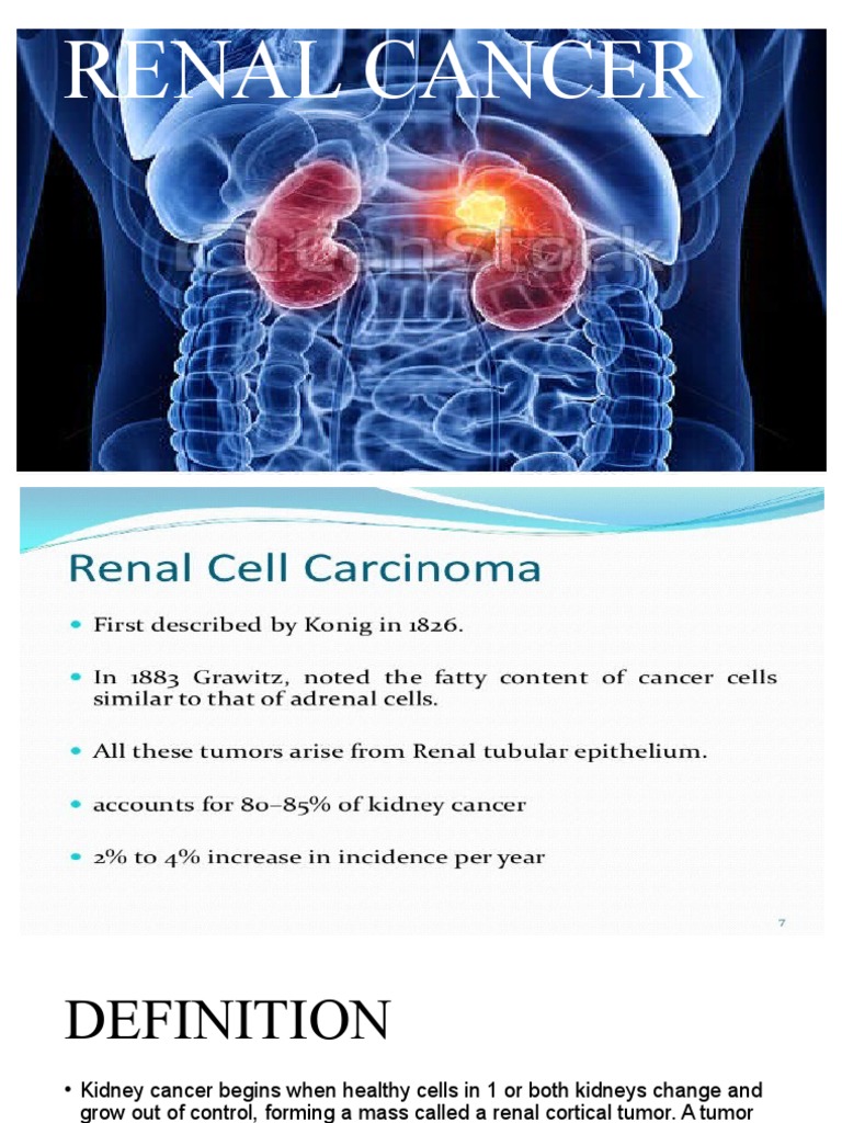 Renal Cancer,Urinary Bladder Cancer,Prostate Cancer,Uterus Cancer PDF