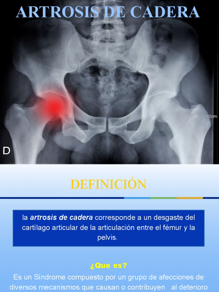 artrosis-de-cadera-s-ntomas-y-tratamiento-pdf-osteoartritis-rodilla